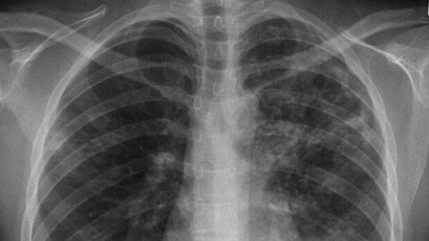 Chest x-ray of a patient with tuberculosis Photo: Supplied