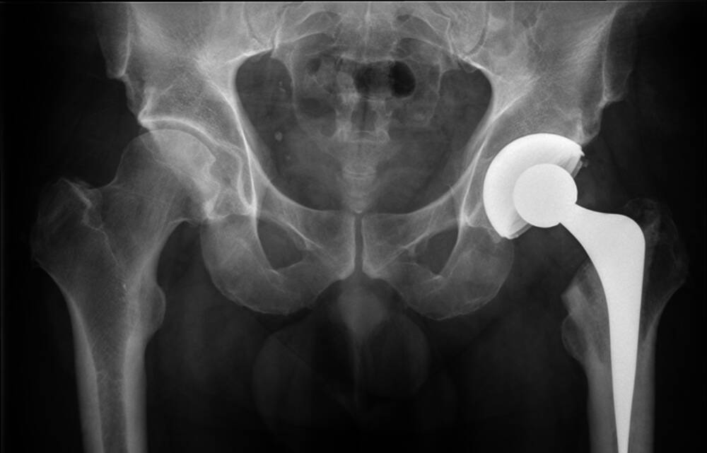 HIP-HOORAY: New MHRA guidelines call for a longer, more thorough process for medical professionals managing  metal-on-metal hip replacement patients.