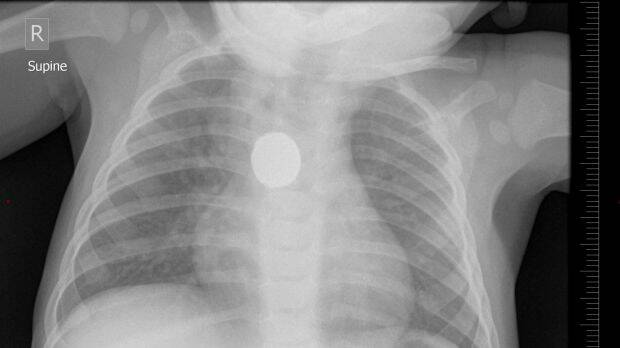 A lithium button battery lodged in the oesophagus of a child.