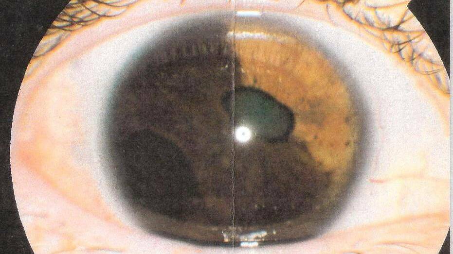 A clinical photo of Susan Vine's eye at the time of enucleation - eye removal - surgery. Picture supplied