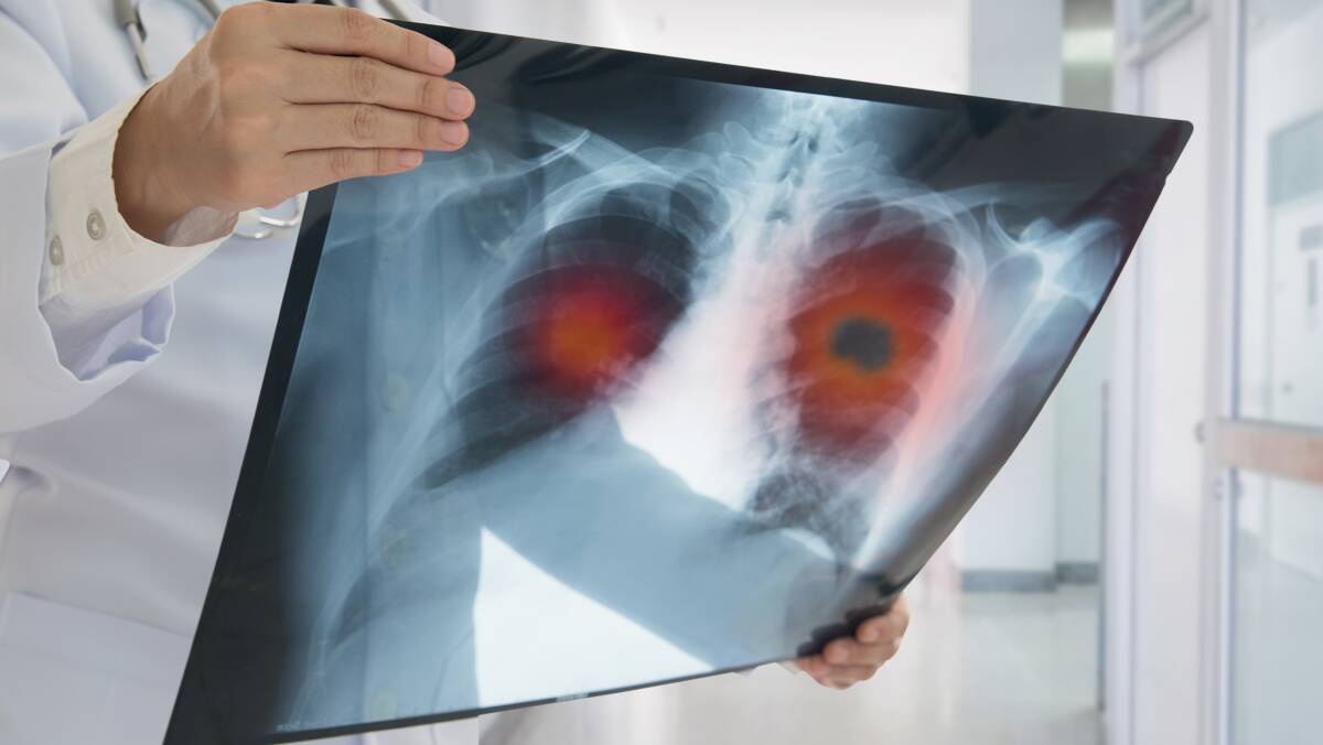 IMPACT: It is estimated there will be more than 12,000 new cases of lung cancer diagnosed in Australia this year, and more than 9000 deaths.