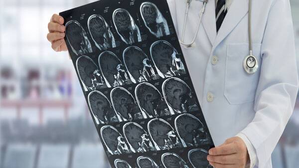 Women more likely to survive stroke but fare worse after