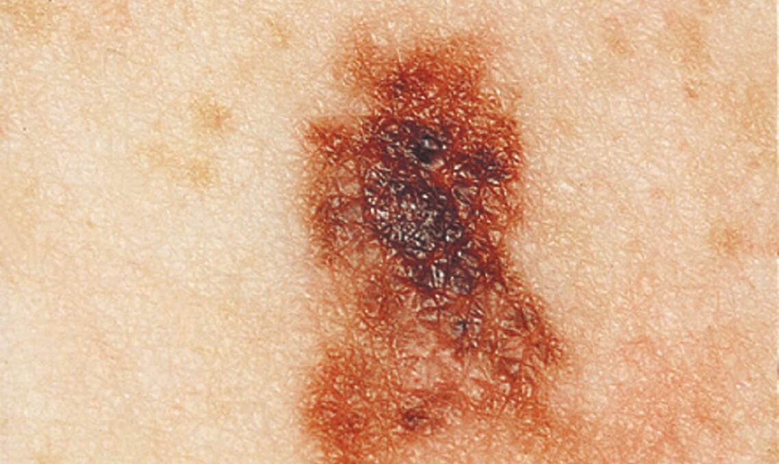 World-first melanoma blood test could save lives