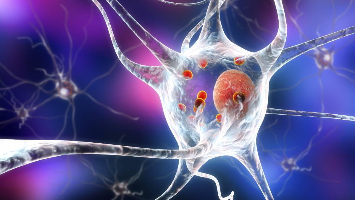 An illustration of a neurone for Parkinson's. Photo: Shutterstock