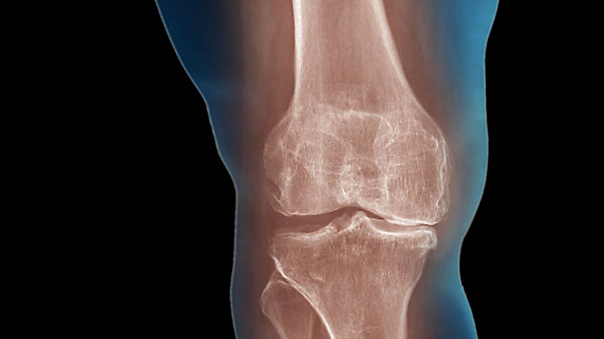 PAINFUL TRUTH: Arthritis doesn't just cause joint pain, it also leads to painful misconceptions.