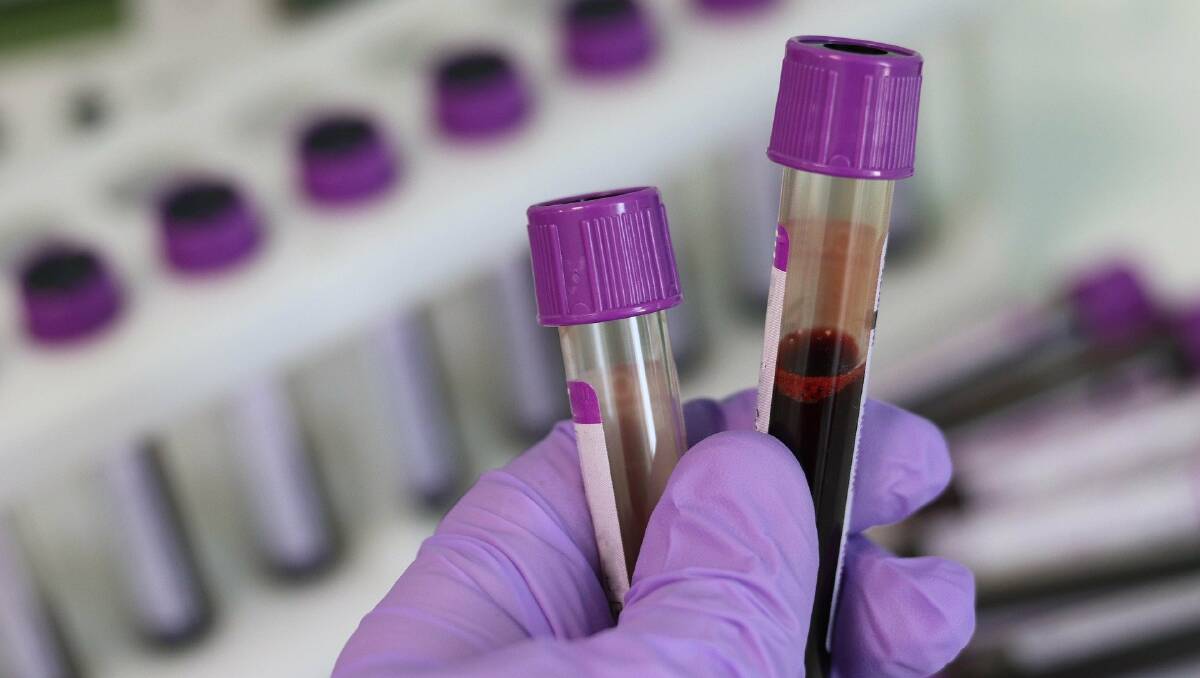 TEST IS BEST: Researchers from UniSA say blood tests should be used to determine the best treatment options for patients with rheumatoid arthritis. 