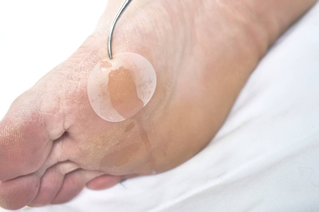 STEPPING UP: Researchers believe a new silicon based, polymer coated dressing could be a game changer for people with diabetic foot ulcers.