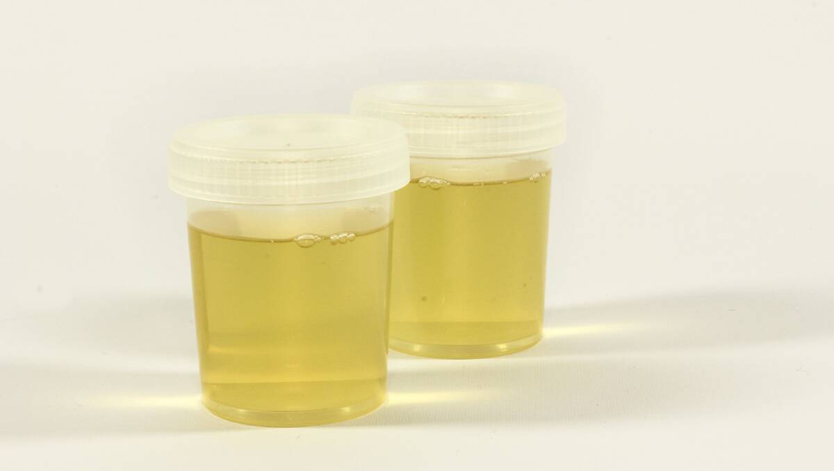BREAKTHROUGH: The new Prostate Urine Risk test could change the face of prostate cancer testing.