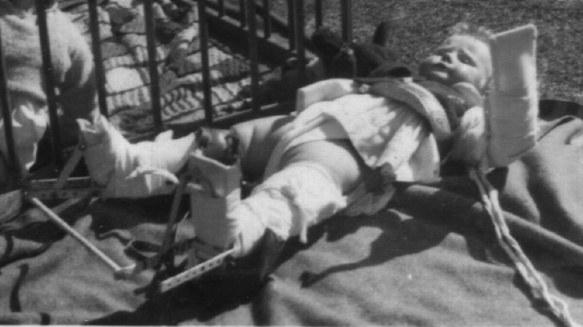 SO MANY CHILDREN: Polio Australia president Gillian Thomas in 1951 in what is known as a double Thomas splint, with arms and legs immobilised.