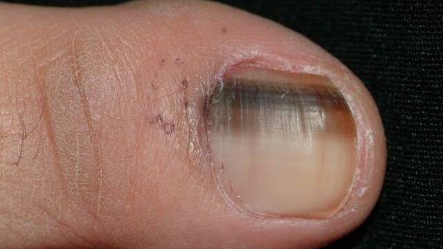 Is the skin around your nails peeling? Know the causes, treatment and more  | Health - Hindustan Times