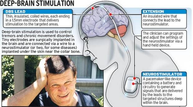 Research will aim to reduce side effects of deep brain stimulation. Image Sydney Morning Herald