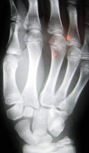 Most arthritis sufferers also have other chronic conditions.