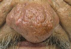 Rhinophyma causes the skin to thicken and appear bulbous and swollen. Wikimedia Commons, CC BY