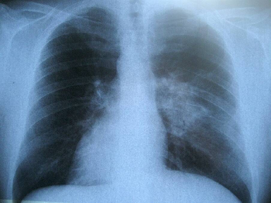 Older age does not increase the chances of a patient dying from lung cancer according to new research.