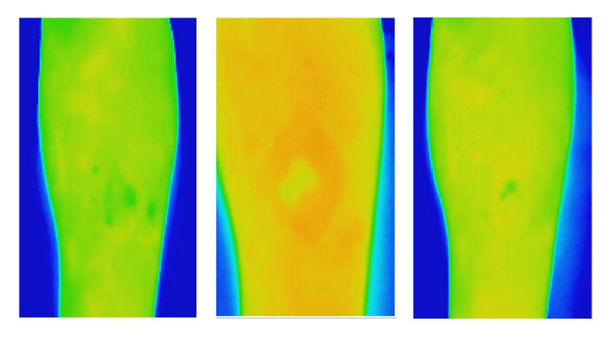 Thermal imaging showing a venous leg ulcer which has healed.