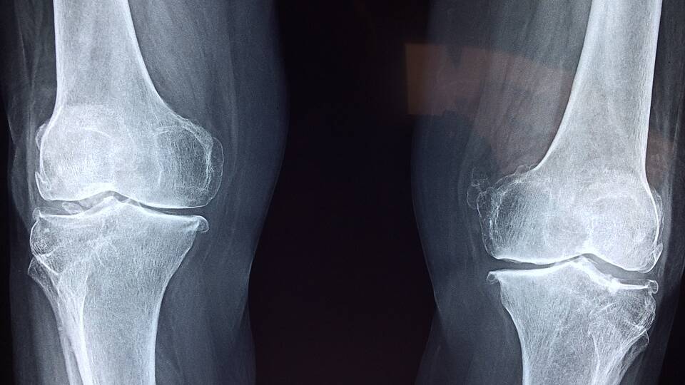 KNEE OSTEOARTHRITIS: New guidelines recommend exercise not surgery or popular therapies.