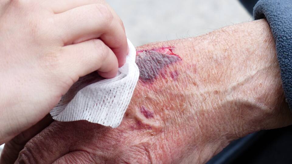Each year more than $3 billion is spent on the treatment of chronic wounds in Australia.