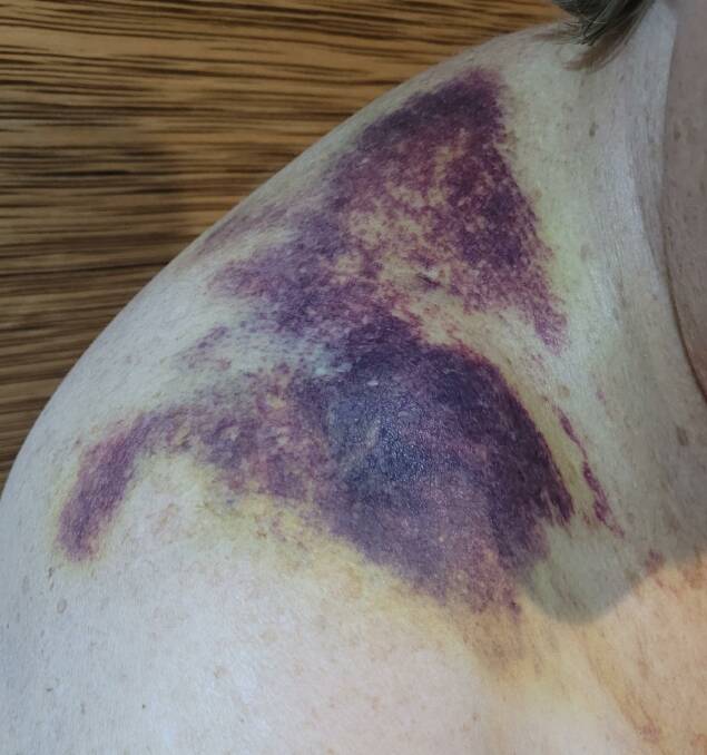 Carol's bruised shoulder a week after the accident. Picture supplied