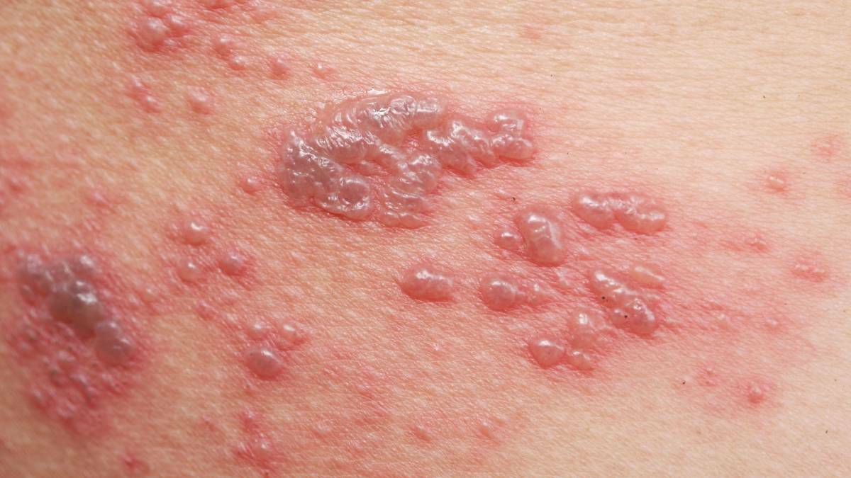 The blistering rash caused by shingles.